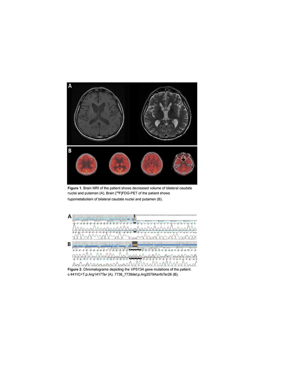 Genetic diagnosis of Chorea-acanthocytosis using whole exome sequencing ...